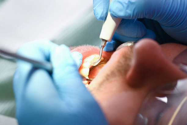 Best Emergency Root Canal Treatment in Piedmont, SC